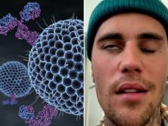 Šta je Remzi – Huntov sindrom od koga boluje Džastin Biber