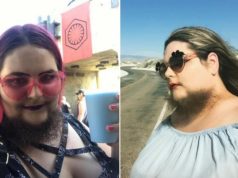 Zbog poremećaja joj raste brada: Volim kako izgledam