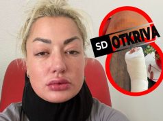 “MOGLA SAM DA UMREM!” Uznemirujuće fotografije Sandre Rešić nakon saobraćajke – Prelomi, polivi i rane