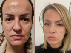 Ermina Pašović prije i poslije 2 estetske intervencije promijenila lični opis, neprepoznatljiva: Bog nas je dao rošave i s krivim nosem!