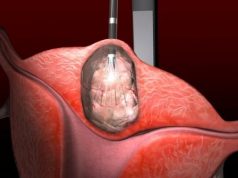 ZBOG RAKA MATERICE UGROŽEN SVE VEĆI BROJ ŽENA: Ovaj tumor ima 6 jasnih simptoma