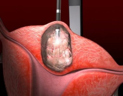 ZBOG RAKA MATERICE UGROŽEN SVE VEĆI BROJ ŽENA: Ovaj tumor ima 6 jasnih simptoma