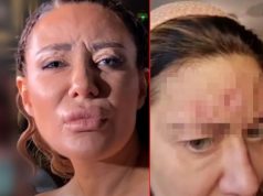 Ožiljci na licu samo su mali pokazatelj svih rezova na duši: Ana Nikolić poslala brutalnu poruku nakon skandala FOTO