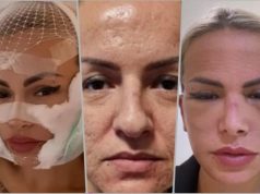 SVA U MODRICAMA I PODLIVIMA: Poslije operacije lica sva se izobličila i deformisana, Ermina Pašović sad želi samo jedno FOTO