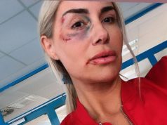 Objasnila misteriju modrica na njenom licu: Progovorila Selma Bajrami