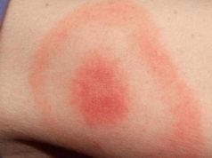 Muškarca ugrizao krpelj, a onda su počeli grozni simptomi: Preminuo od rijetke bolesti slične eboli