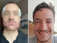 OTIŠAO U TURSKU NA TRANSPLANTACIJU BRADE, 4 MJESECA KASNIJE SE UBIO Priča o mladiću (24) potresla svijet: Otkrivena jeziva tajna o hirurgu koji ga je operisao