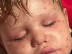 Noćna mora dvogodišnjaka, bori se za život nakon 150 uboda: “Koža mu je požutjela, organi su zatajili…”