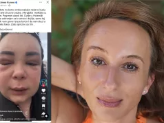 “Pogrešan ubod, cijelo lice natečeno”: Šokantna reakcija na botoks podigla buru